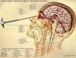 From Lobotomy to Lobotomy Piercing: A Historical Perspective