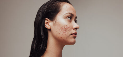 How to Remove Acne Scars Naturally in a Week